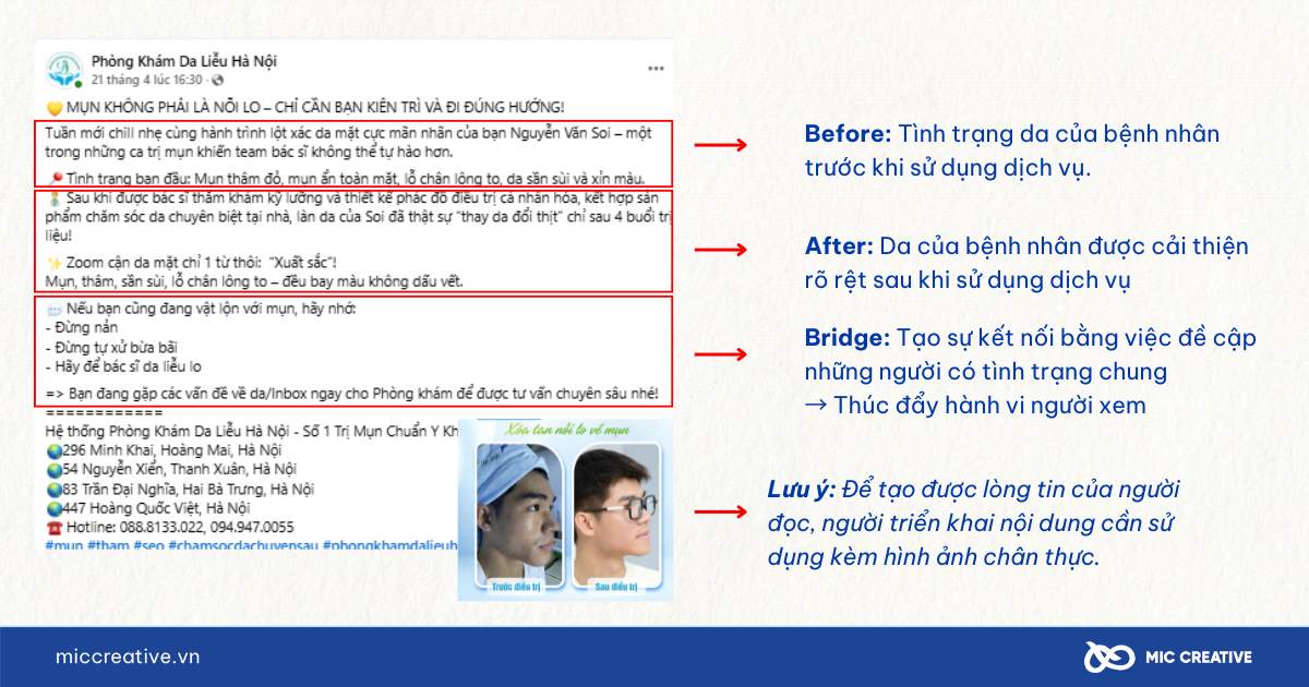Công thức BAB - Các công thức viết content